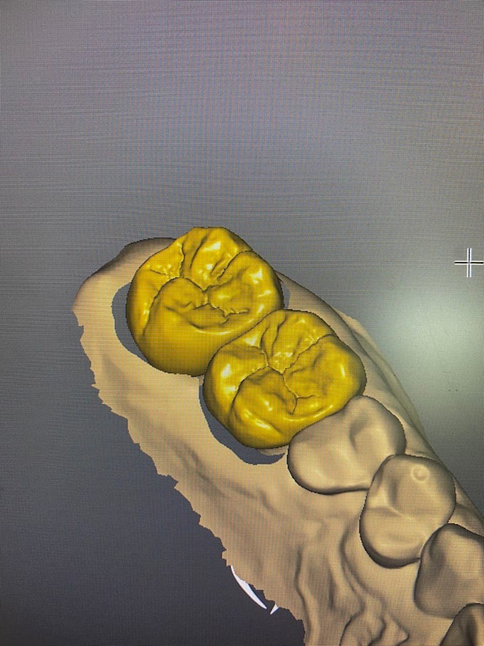 Design your dental crowns, bridges, veneers, inlays etc by Helga_mills ...