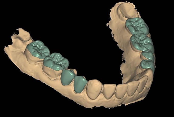 Do dental cad design by Merchercoles | Fiverr
