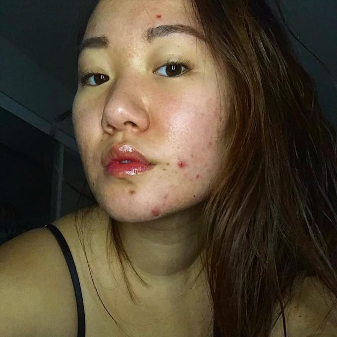 Remove acne and blemish form picture by Patelronak222 Fiverr