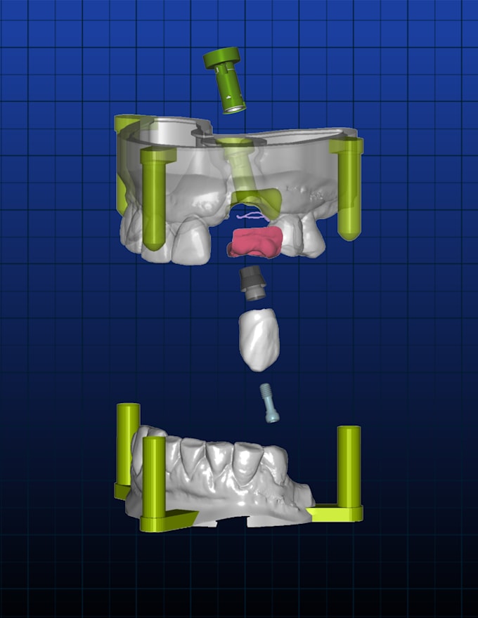 Design your dental restorations for 3d printing or milling by