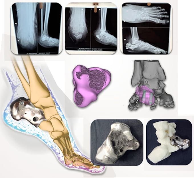 create personalized orthopedic implants