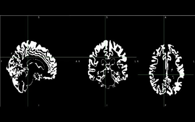 preprocess your mri images