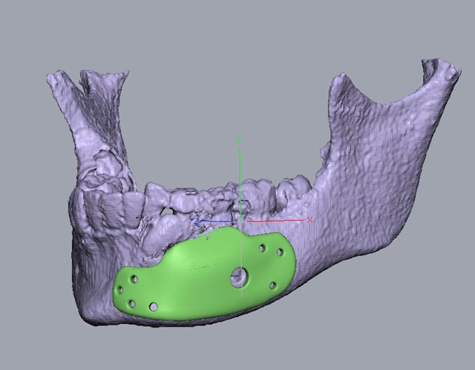 oral and maxillofacial implant designing