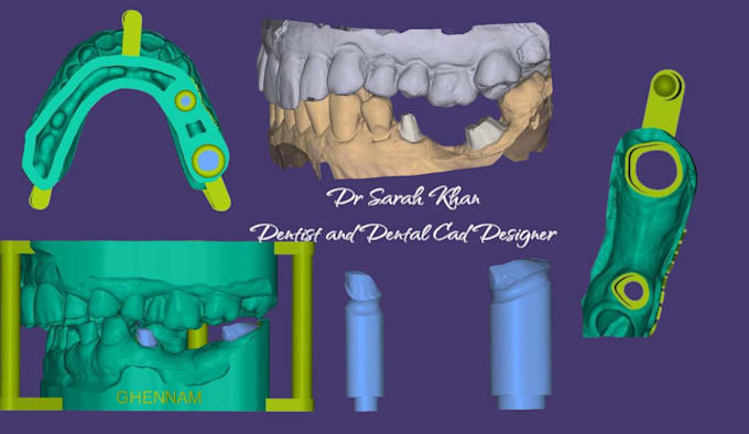 design crown, bridges, smile, veneer  dental cad using exocad