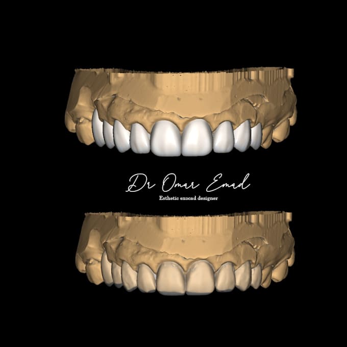 exocad design esthetic veneers, crowns, implants