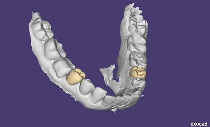 do dental design using exocad software based on your scans