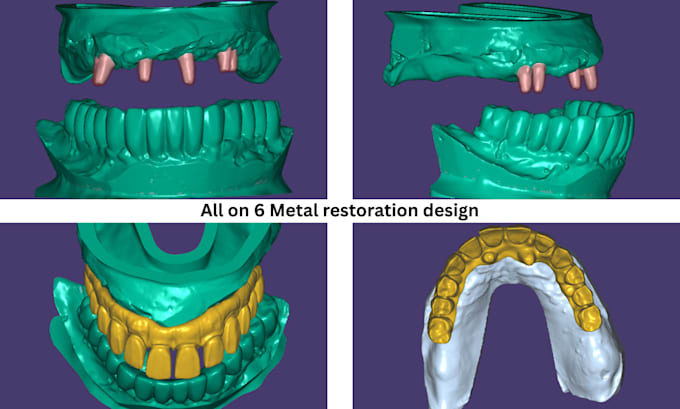 create high quality dental restorations using exocad
