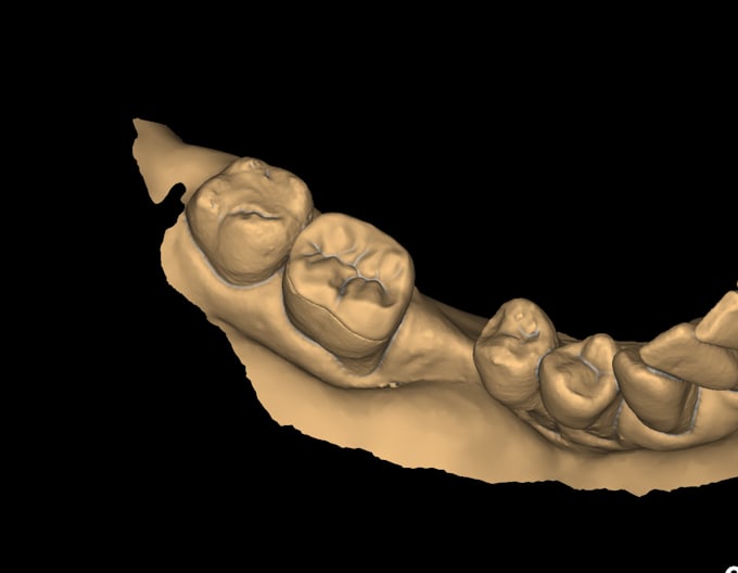 design crown and bridge using exocad