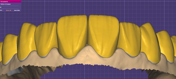 design crown bridge and dental restorations in exocad