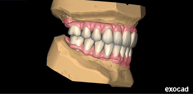 do highly ethetics dental restorations aox bridges on exocad