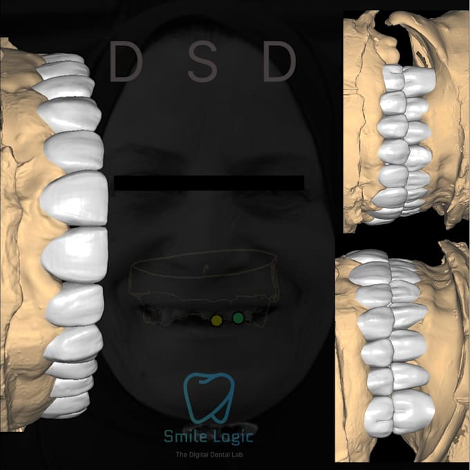 create esthetic veneer designs and dsd in exocad