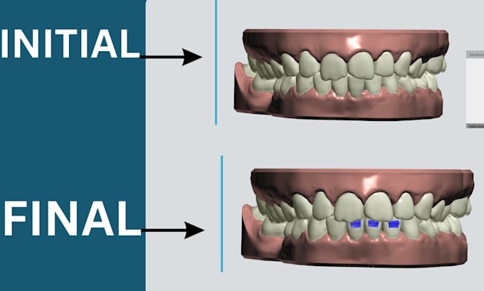 do dental clear aligner treatment planning on onyxceph and 3shape