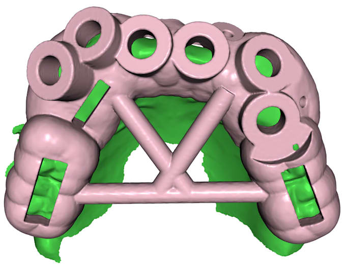 design a surgical guide for implant surgery