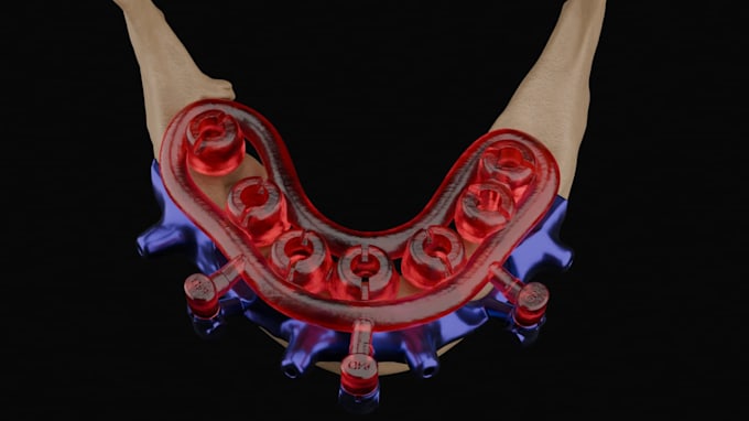 surgical stackable guide design