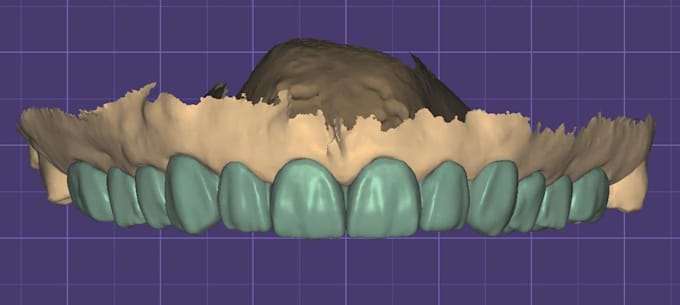 design crown and bridges in exocad