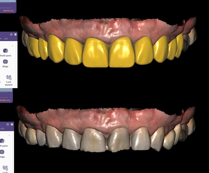 design dental mock ups