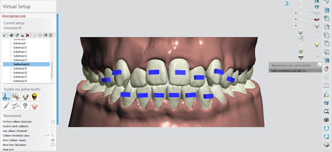custom aligner treatment plans with 3d clincheck