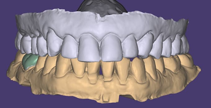 design your exocad crown accurately