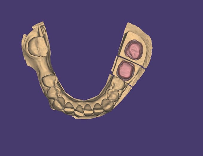 dental crown design exocad