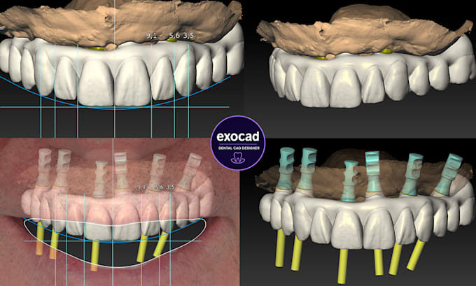do professional exocad dental design for you