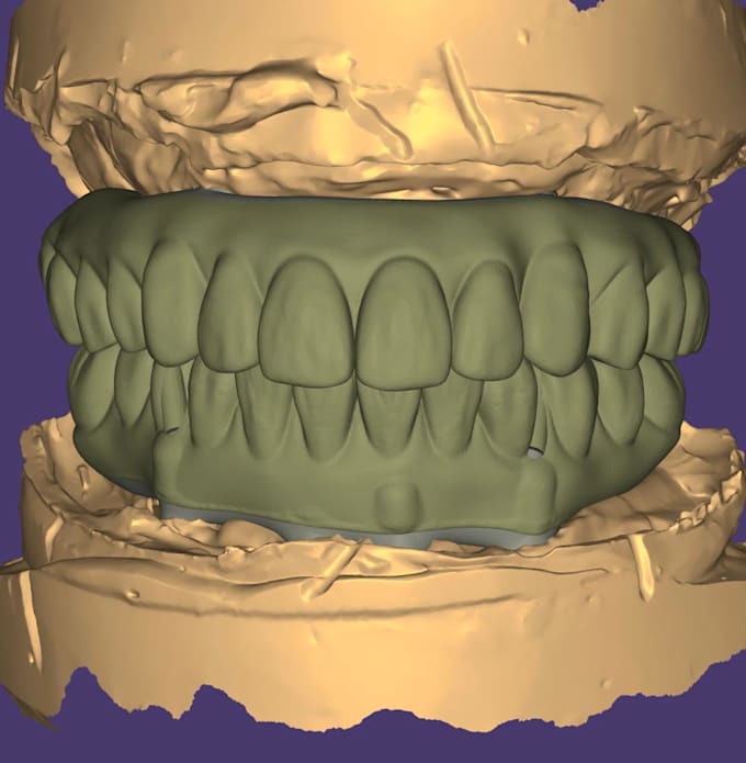 design crowns, bridges, implants, full arch cases using exocad