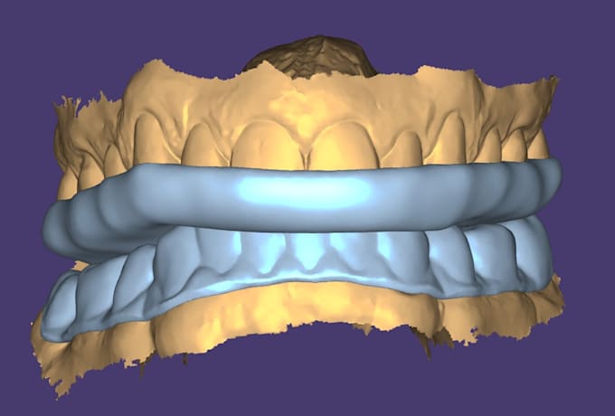 do dental cad design for splints in exocad