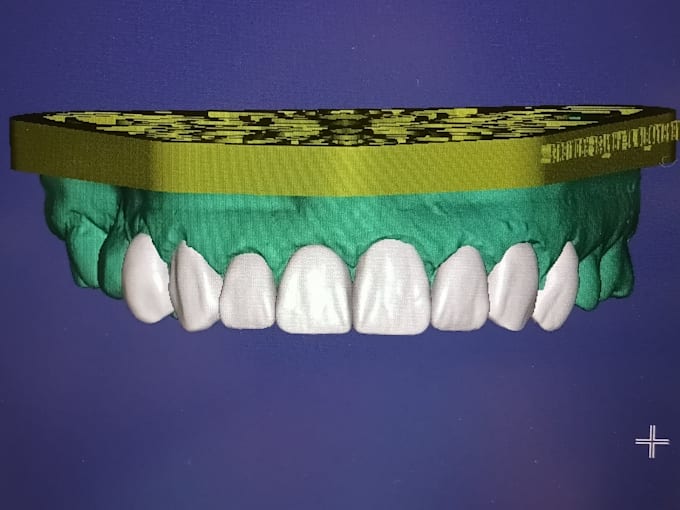 create high quality dental cad desings using exocad