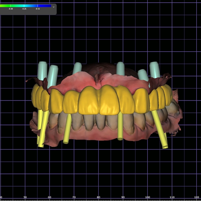 design high precision dental cad restorations, crowns, and veneers