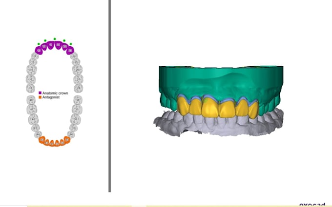 do precise dental cad cam designing for crowns and partial dentures