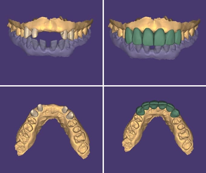 design precise exocad dental crowns, bridges and veneers