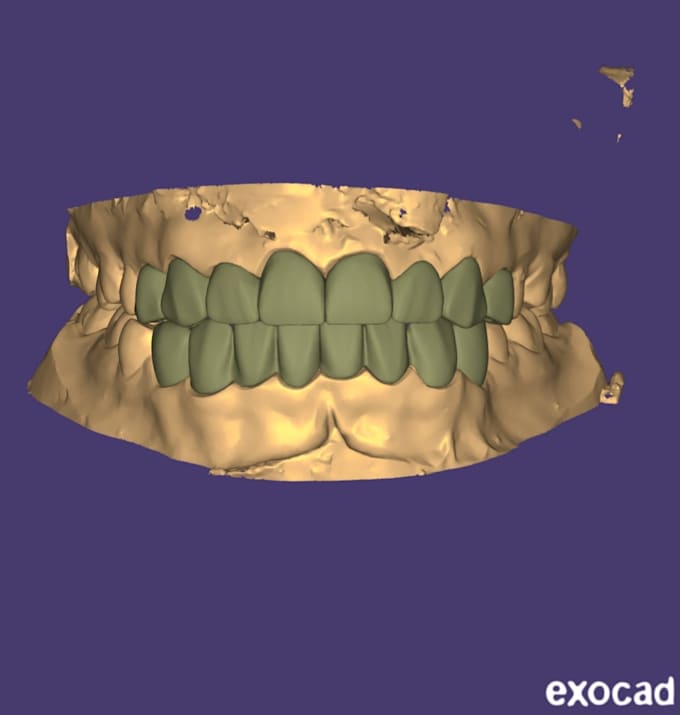 design custom crowns, bridges using exocad