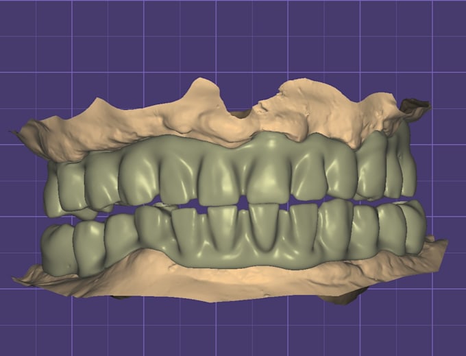 do exocad dental cad design for crowns, bridges and more