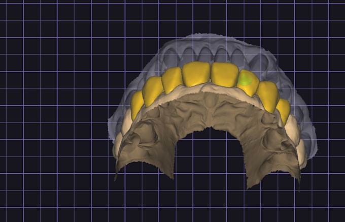 design custom exocad anterior smile makeovers and full arch restorations