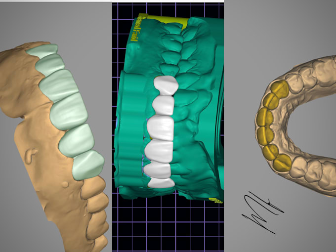 design crown and bridge using exocad