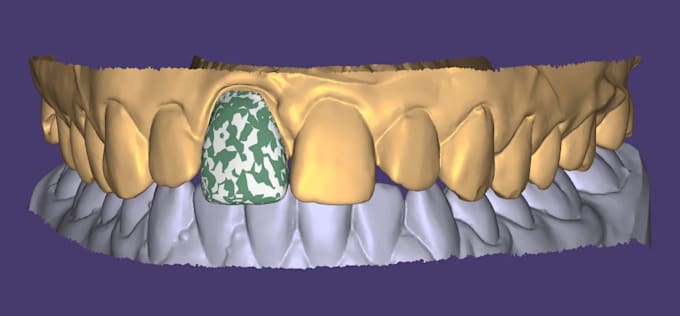 design aesthetic dental crown veneers and bridges using exocad