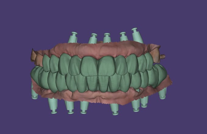all on x full arch implant prostheses using exocad