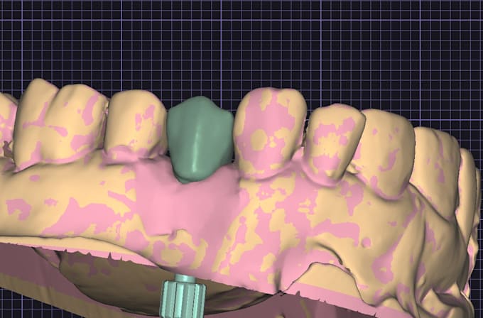 make your dental implant crown design