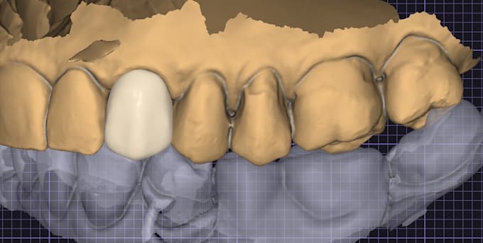 make dental crown design on prepared tooth for you