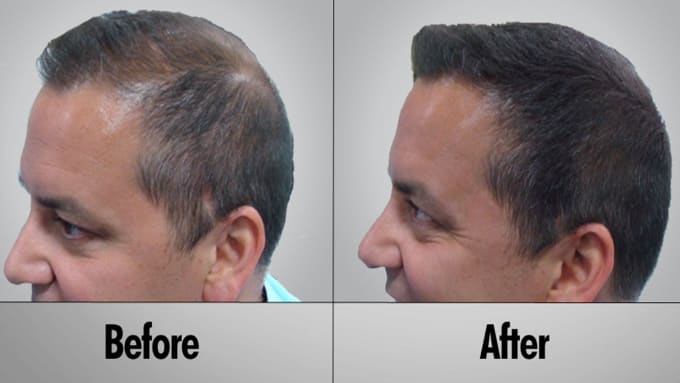 Stop Hair Loss And Regrow Hair By Davidconfl