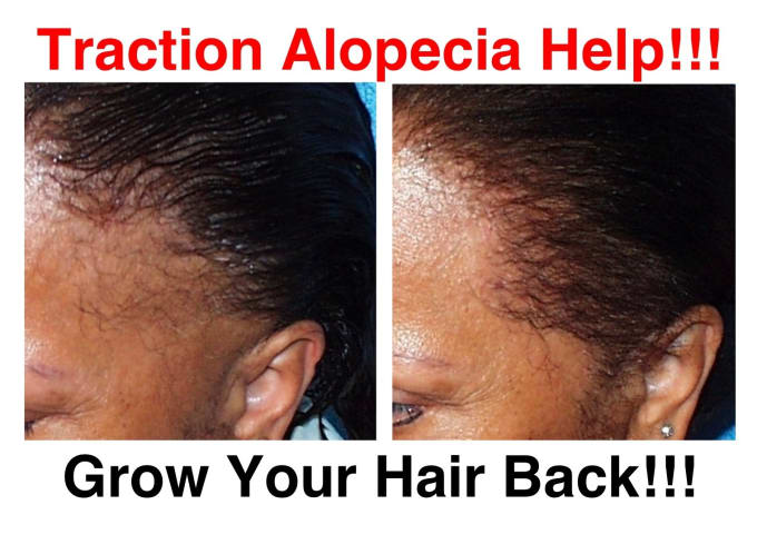 Give Traction Alopecia Hair Loss Formula By Megalove