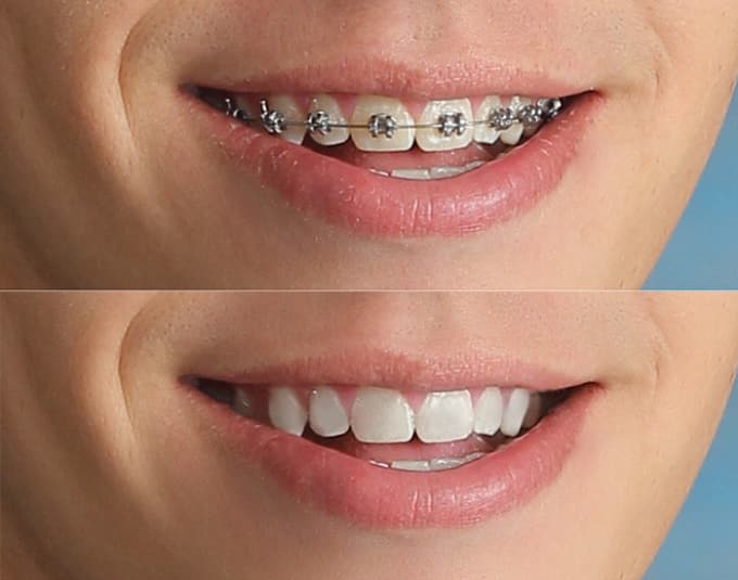 how to take off braces braces colors wheel
