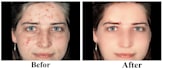 remove dark spots on face, damage, pox scars etc
