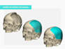do  3d maxillofacial reconstruction and craneal prosthesis