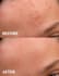 remove your acne marks, pimples, dark circles, and eye bags