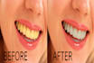 white your teeth and remove stains quickly