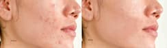 remove acne, blemishes, and repair old image efficiently