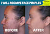 do remove your face pimples in 24 hrs