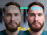 remove pimple and spot from face and body