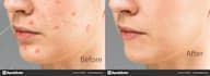 remove wrinkles, blemishes, spots, pimples from your skin