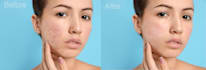 remove pimples from your images
